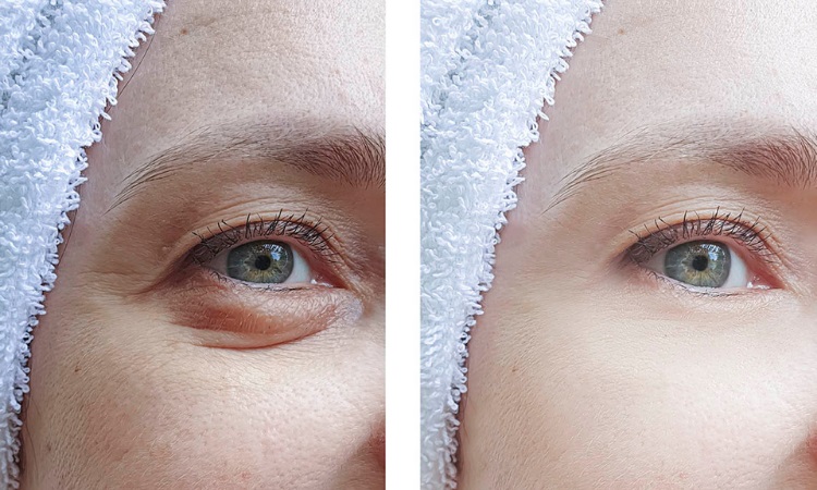 Blepharoplasty Kalamazoo