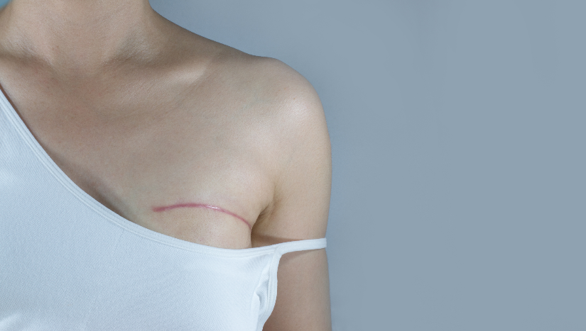 Breast Reconstruction Kalamazoo