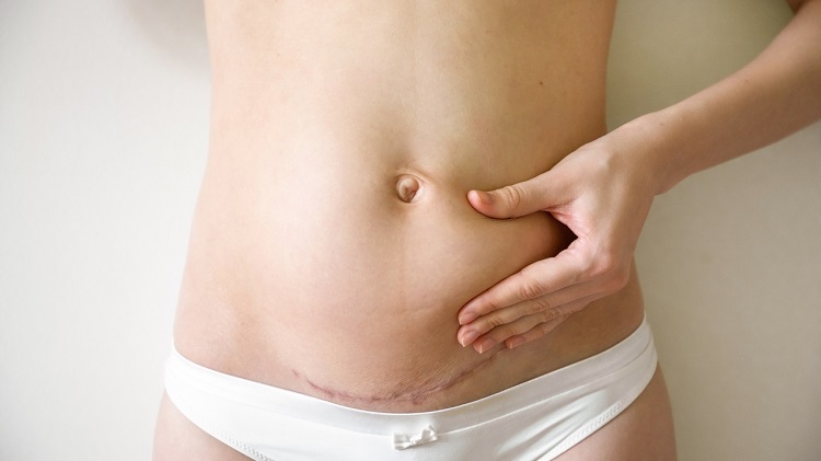 What is an Abdominoplasty? - West Michigan Plastic Surgery